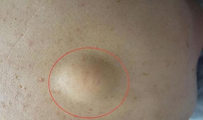 脂肪瘤最新研究，从未知挑战到自我超越的突破之旅