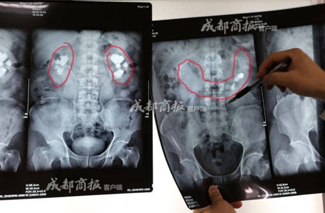 马蹄肾最新研究动态与科普解读速递